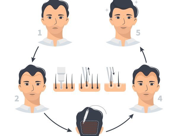 Hair Transplant with FUE Technique